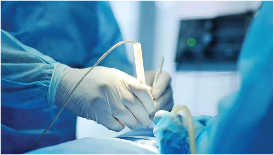 частичное обрезание радиоволновым скальпелем