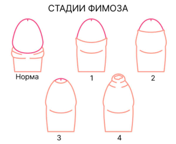 Стадии фимоза
