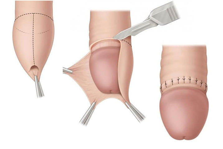 обрезание крайней плоти