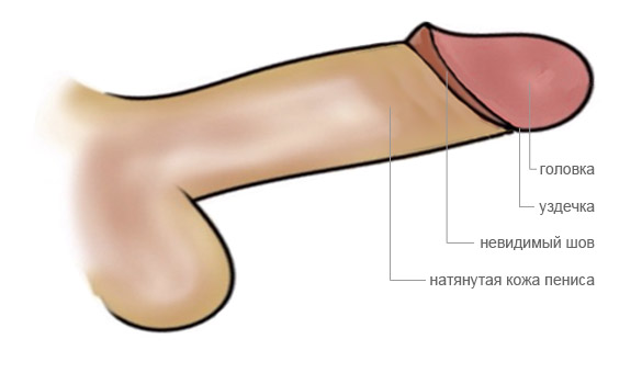 Схема обрезания: Пенис после тугого обрезания крайней плоти